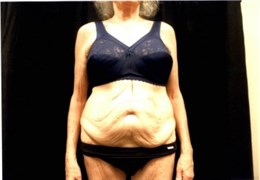 Abdominoplasty (Before)