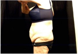 Abdominoplasty (Before)
