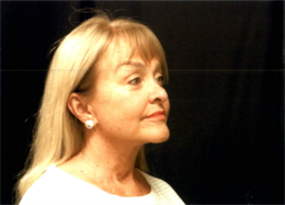 Face and Neck Lift with Smartlipo Neck and Jowls