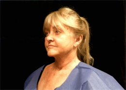 Face and Neck Lift with Smartlipo Neck and Jowls