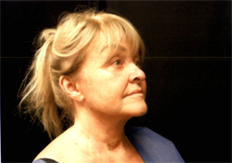 Face and Neck Lift with Smartlipo Neck and Jowls