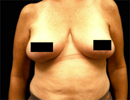 Breast Reduction (inferior pedicle technique).