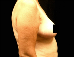 Breast Reduction (inferior pedicle technique).