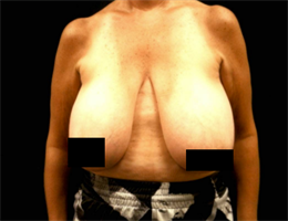 Breast Reduction (inferior pedicle technique).