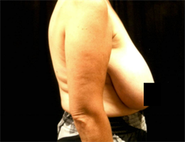 Breast Reduction (inferior pedicle technique).