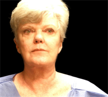 Face and Neck Lift with Smartlipo Neck and Jowls