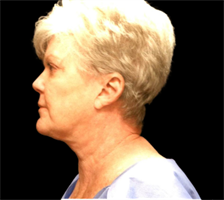 Face and Neck Lift with Smartlipo Neck and Jowls