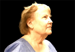Face and Neck Lift with Smartlipo Neck and Jowls